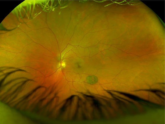 Crystal retinal